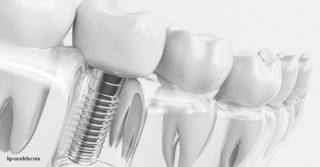 ข้อดีข้อเสีย ของรากฟันเทียม หลายสิ่งหลายอย่างสามารถนำไปสู่การสูญเสียฟันได้ ซึ่งรวมถึงการบาดเจ็บ การสลายตัว ความชรา